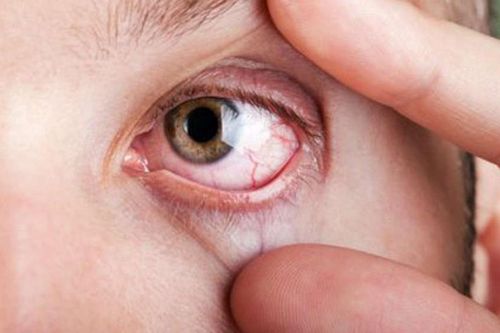 Thoái hóa giác mạc - tác động môi trường đến 'cửa sổ tâm hồn'