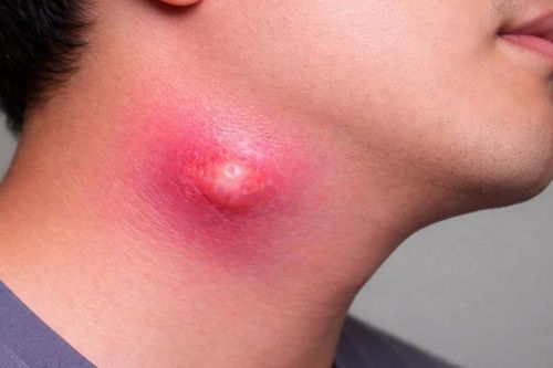 Áp xe cổ đe dọa tính mạng người bệnh nếu phát hiện muộn