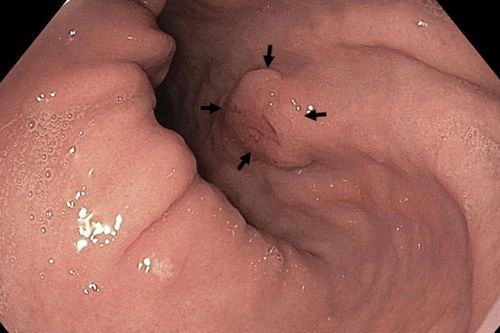 33 tuổi, người phụ nữ mắc ung thư dạ dày giai đoạn cuối