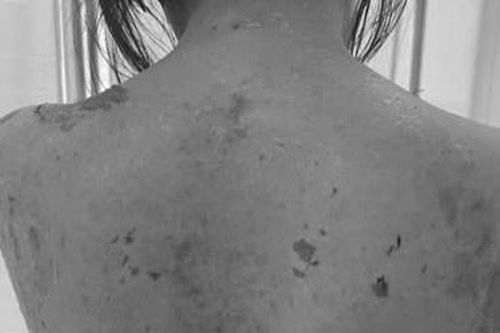 Bác sĩ sốc khi bệnh nhân đến khám với toàn thân bong tróc