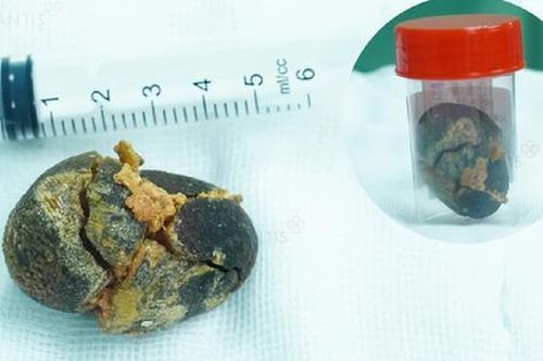 Đi khám sức khỏe định kỳ, người phụ nữ 'sốc' khi phát hiện điều bất ngờ