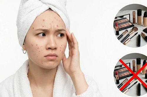 Trang điểm khi trị mụn: Nên hay không? Lời khuyên từ chuyên gia
