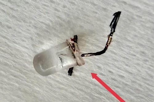 Bác sĩ căng thẳng gắp bóng đèn trong đường thở bé gái