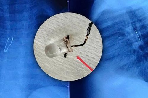 Bé 9 tháng tuổi sặc bóng đèn LED, nhập viện nguy kịch