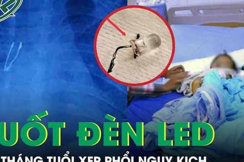 Kinh hoàng: Bé 9 tháng tuổi xẹp phổi vì nuốt bóng đèn LED