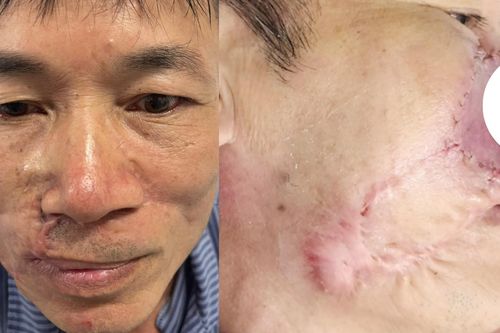 Ung thư biểu mô tế bào đáy tái phát: Khi 'mổ đi mổ lại' vẫn không hết bệnh