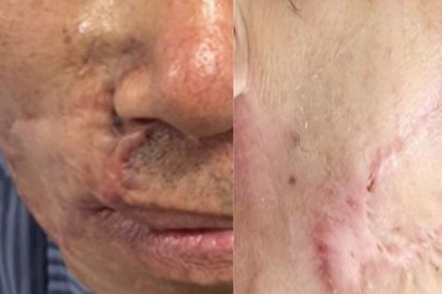 Vì sao 'mổ đi mổ lại' vẫn không hết ung thư da?