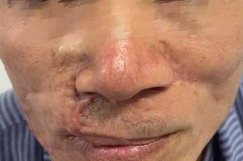 Ung thư da vẫn tái phát dù đã phẫu thuật nhiều lần?