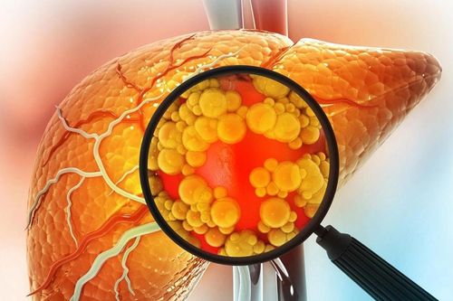Tìm ra cơ chế đảo ngược gan nhiễm mỡ mà không cần ăn kiêng