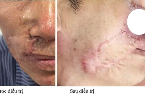 Ung thư biểu mô tế bào đáy tái phát liên tiếp, lời cảnh báo từ bác sĩ