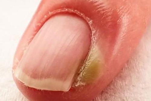 Chín mé ngón tay xử trí ra sao?
