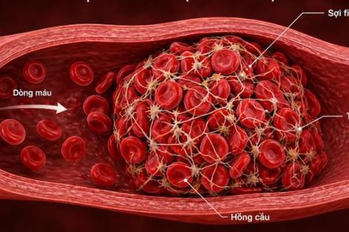 2 cách đơn giản ngăn ngừa cục máu đông