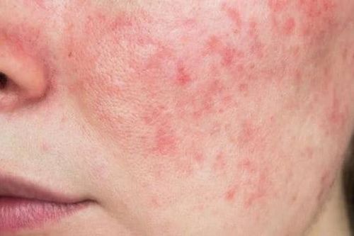 Hiểm họa khi tự ý lạm dụng thuốc, mỹ phẩm chứa corticoid