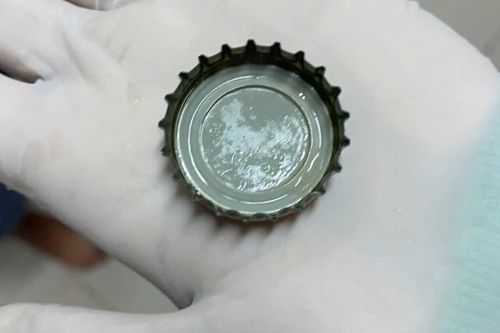 Cấp cứu người đàn ông ở Cần Thơ nuốt nhầm nắp chai bia trong bữa nhậu