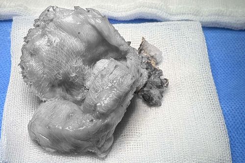 'U gạc' nằm im âm thầm 4 năm sau nâng ngực