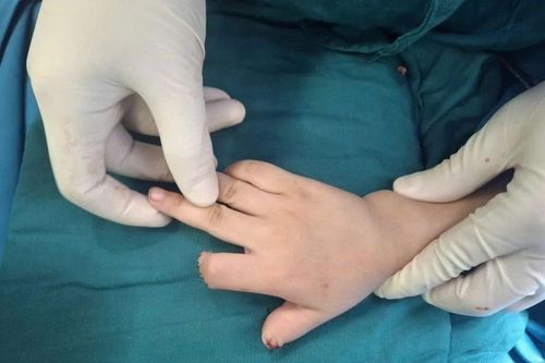 Bé 5 tuổi đứt lìa 2 ngón tay khi chơi xe điện tự chế