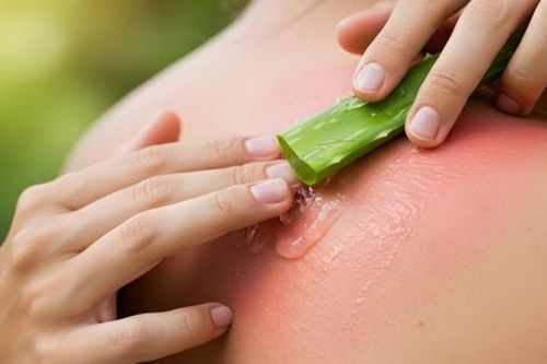 Cách phục hồi làn da bỏng nắng sau khi đi biển