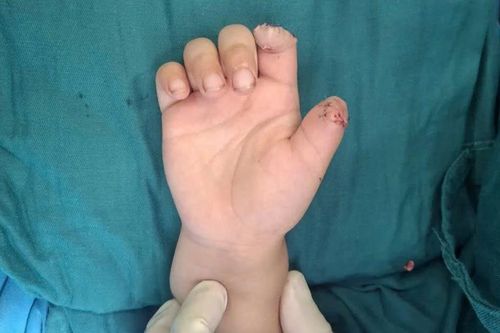 Hà Nội: Bé trai 5 tuổi đứt rời 2 ngón tay khi chơi xe điện tự chế