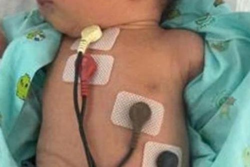 Trẻ sơ sinh mắc hội chứng di truyền hiếm gặp
