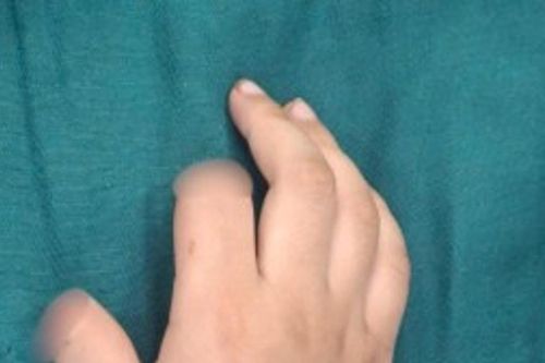 Hà Nội: Bé trai 5 tuổi đứt lìa 2 ngón tay khi chơi xe điện tự chế