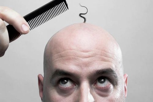Quốc gia nào có nhiều người hói nhất thế giới?