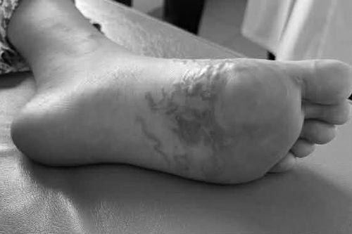 Nhiễm cùng lúc 5 loại ký sinh trùng vì món ăn nhiều người thích