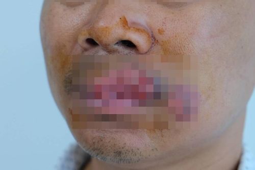 Bị người nhà cắn mất môi, người đàn ông nhập viện