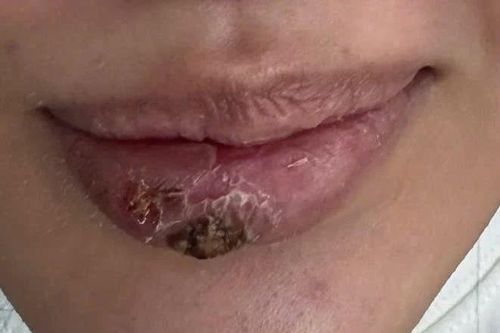 Một thiếu nữ bị biến dạng môi nghiêm trọng do tiêm filler tại spa