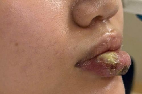 Tiêm 'giải filler' tại cơ sở không phép, người phụ nữ biến dạng môi