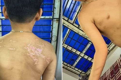 Bắt tạm giam người đàn ông bạo hành con trai 7 tuổi, gây thương tật 36%