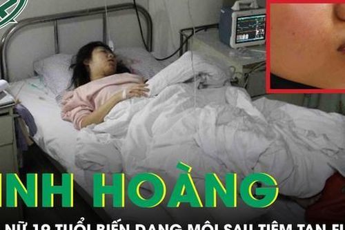 Thiếu nữ 18 tuổi biến dạng môi sau tiêm tan filler tại cơ sở thẩm mỹ chui