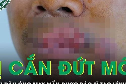 Người đàn ông bị cắn mất môi phải trải qua ca tạo hình phức tạp