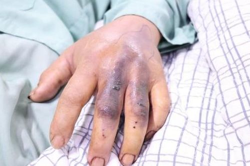 Người đàn ông 62 tuổi nhập viện cấp cứu do bị rắn hổ mang cắn khi đi làm đồng
