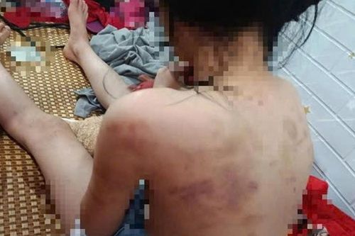 Nữ sinh lớp 4 bị nhóm bạn hành hung, cơ thể nhiều vết thâm tím