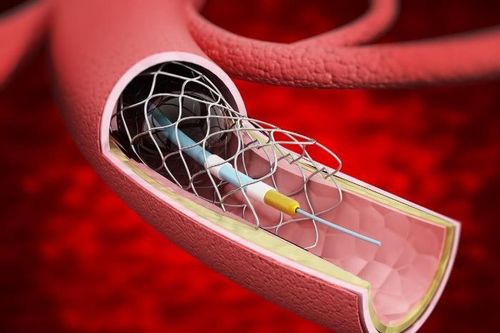Đặt stent mạch vành có hết đau ngực?