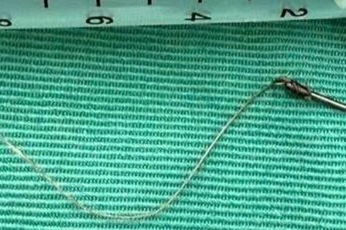 Bệnh viện Đà Nẵng gắp thành công lưỡi câu cắm sâu trong thực quản bệnh nhân