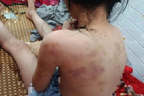 Hé lộ nguyên nhân vụ nữ sinh lớp 4 ở Cao Bằng bị nhóm bạn hành hung, cơ thể nhiều vết thâm tím