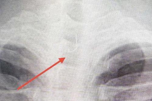 Sau ăn cá người đàn ông 46 tuổi bị mắc lưỡi câu sâu trong thực quản