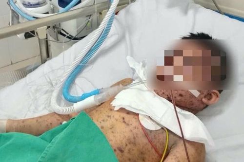 Thủy đậu tấn công vào máu, bé trai 6 tuổi nguy kịch