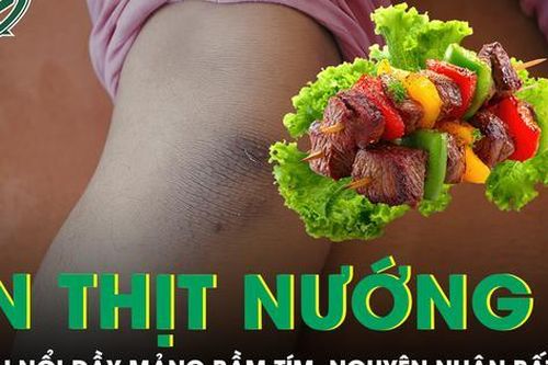 Bé trai nổi đầy mảng bầm tím sau bữa ăn thịt nướng, bác sĩ phát hiện nguyên nhân bất ngờ