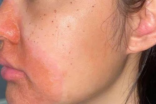 Cảnh báo biến chứng viêm da tiếp xúc nặng sau peel da tại spa