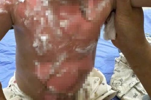 Bé trai 22 tháng tuổi nguy kịch vì bỏng nước sôi, cảnh báo sai lầm nhiều gia đình mắc phải