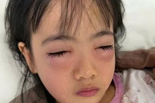 Bé gái 5 tuổi bị viêm kết mạc dị ứng sau khi chơi thổi bong bóng xà phòng