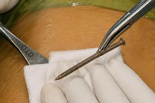 Đinh bắn xuyên bụng khi sửa đồ tại nhà