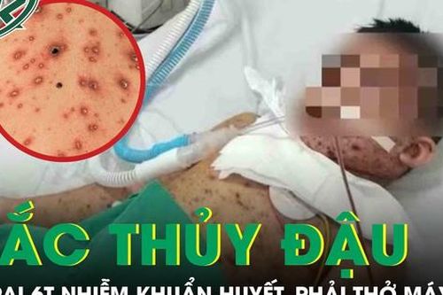 Biến chứng thủy đậu, bé trai 6 tuổi nhiễm khuẩn huyết, phải thở máy nguy kịch