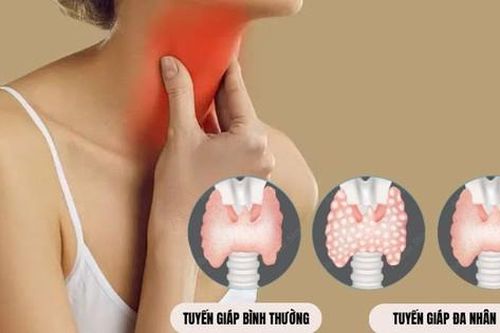 Những bệnh tuyến giáp ngày càng phổ biến trong cộng đồng