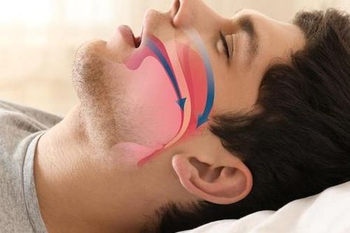 Hội chứng ngưng thở khi ngủ: Biện pháp nào để điều trị hiệu quả?