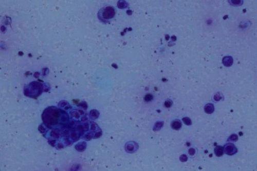 Bé 4 tuổi khỏe mạnh bất ngờ mắc cùng lúc 2 bệnh do virus VZV