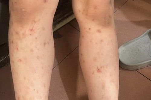 Da nổi mẩn, mụn mủ sau đi bơi: Bác sĩ chỉ cách phòng tránh