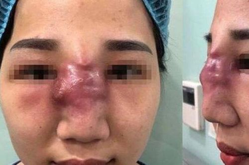 Mỗi năm Việt Nam có 25.000-35.000 ca biến chứng thẩm mỹ